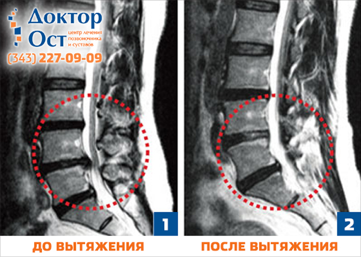Удаленная грыжа позвоночника Удаленная грыжа позвоночника