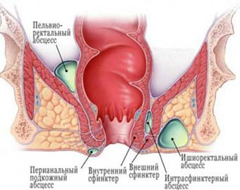 Парапроктит – болезнь новорожденных и грудничков