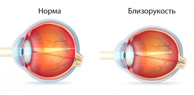 Развитие близорукости у детей можно притормозить специальными линзами